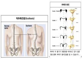 변형성배병증(척추측만증)의 종류와 역학